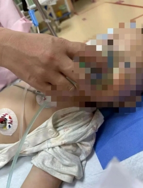 蛋壳暗藏针孔！1 岁宝宝吃下邻居投毒的鸡蛋，3次病危抢救后留下严重后遗症，邻居自首称“想毒黄鼠狼”……