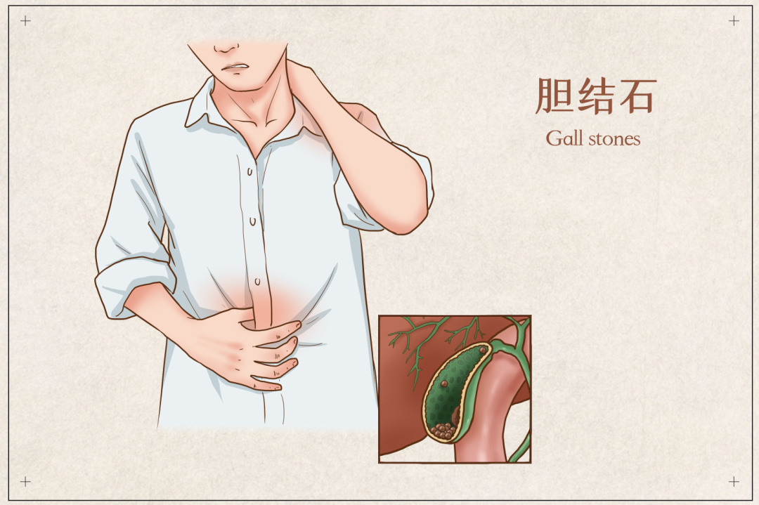 知名演员自曝胆被摘除！为什么不吃早饭这么伤胆？