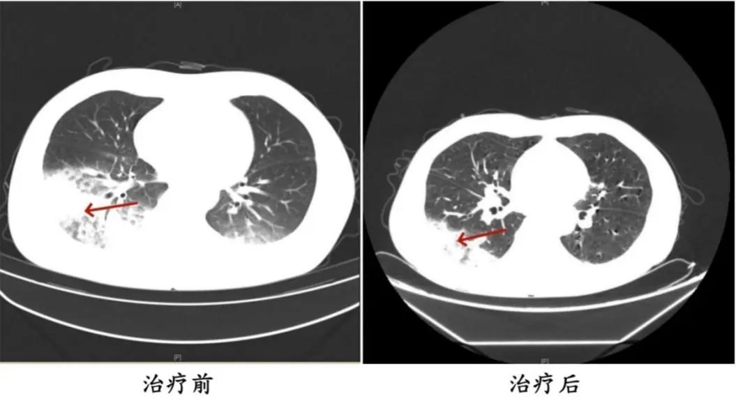提醒｜吹了3天空调，男子左肺“白”了一半！
